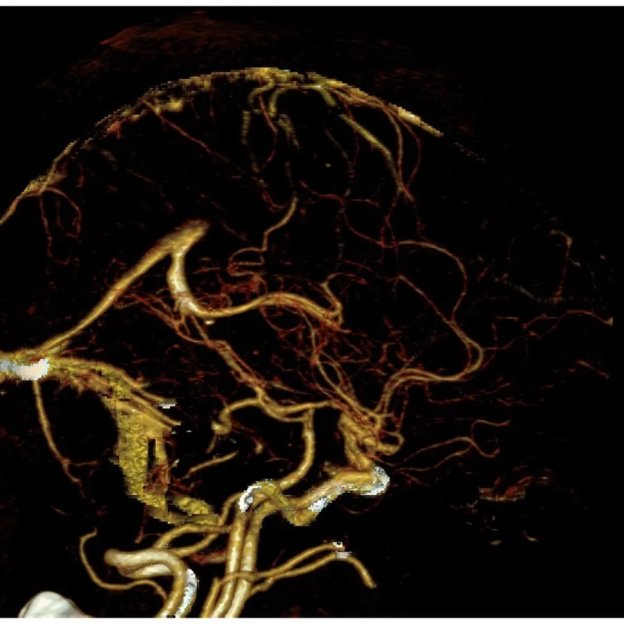 A CT angiogram of the head: gold cerebral vessels branching against black.