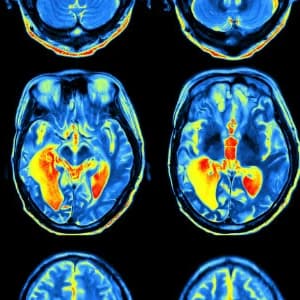 A grid of axial MRI brain slices in false colour, blue and amber on black.